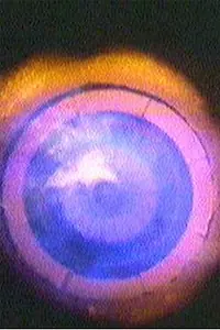 Постер к фильму «A Right to Refuse? (1981)»